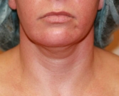 Feel Beautiful - Liposuction Neck San Diego Case 11 - Before Photo